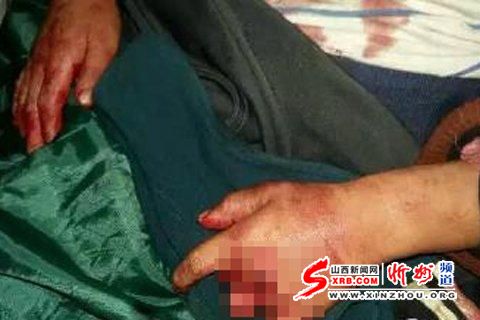 湖南6岁男童因吵女子睡觉被砍断手指和生殖器